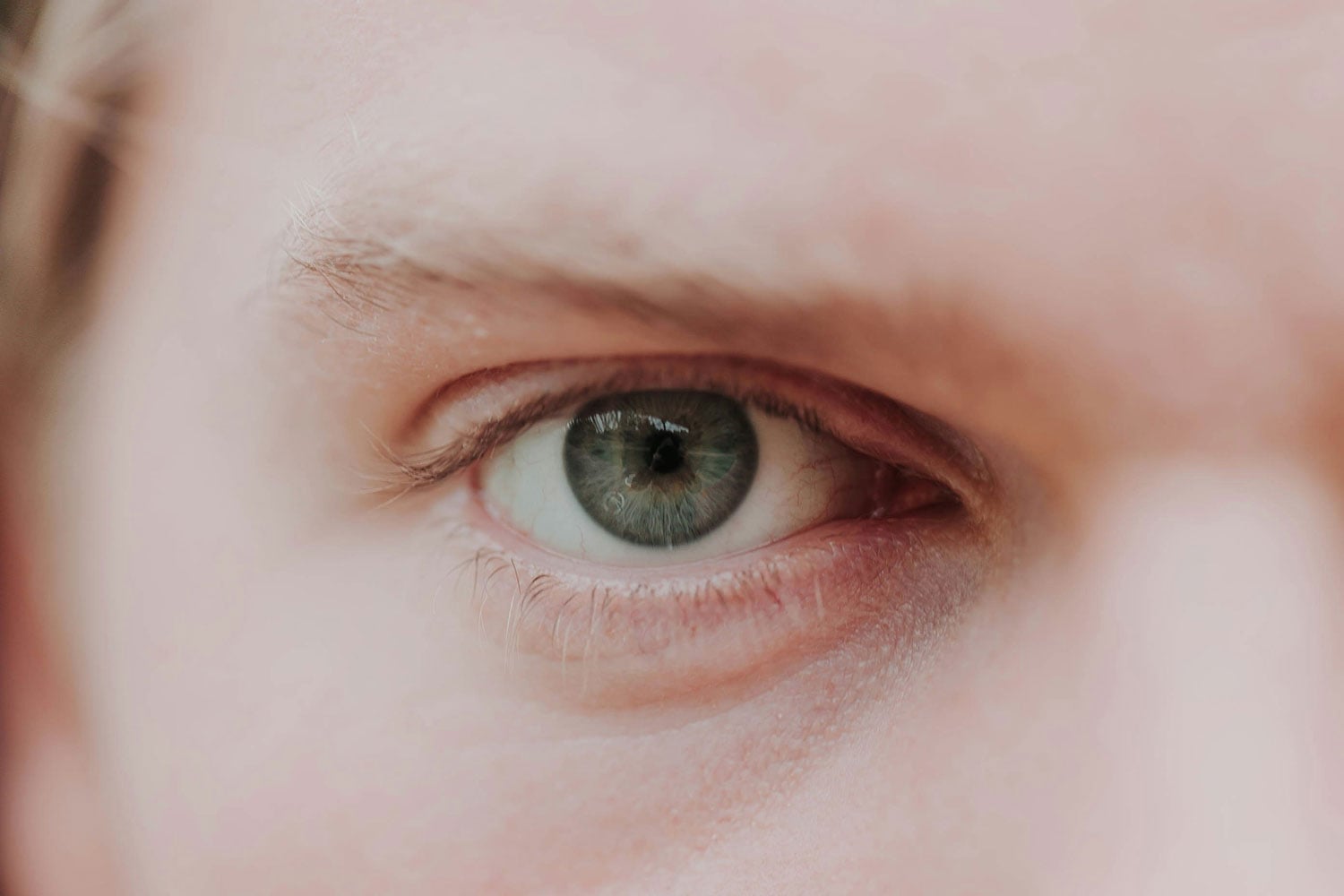 puffy-eyes