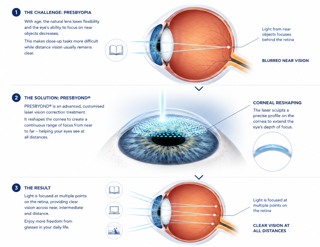Diagram of the eye explaining aging lens and blurred near vision, and the Presbyond laser treatment.
