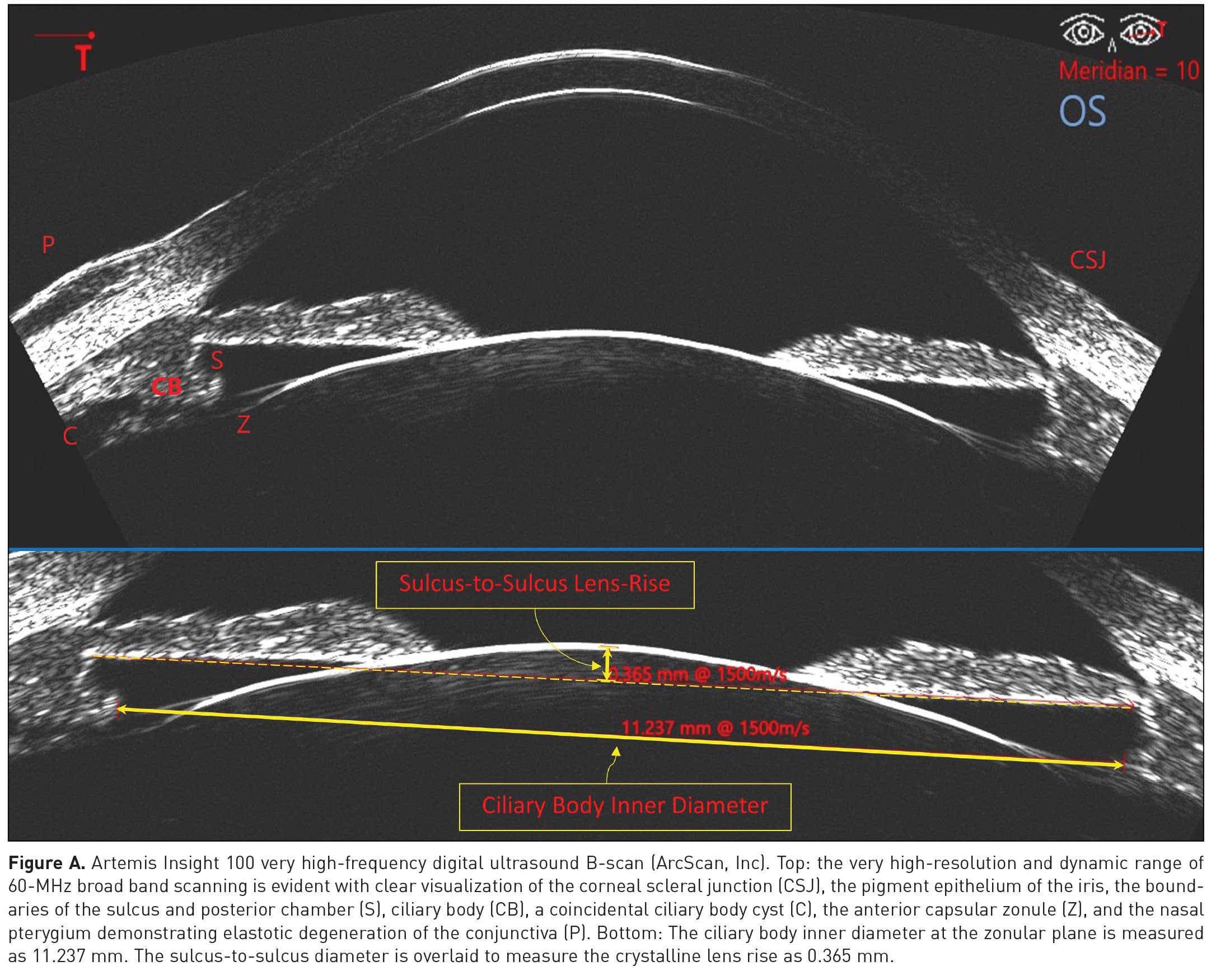 scan-of-eye-through-the-laser