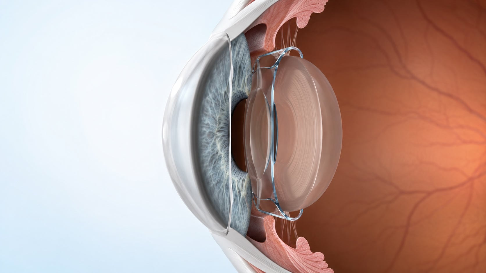 icl-lens-options-direct-from-london